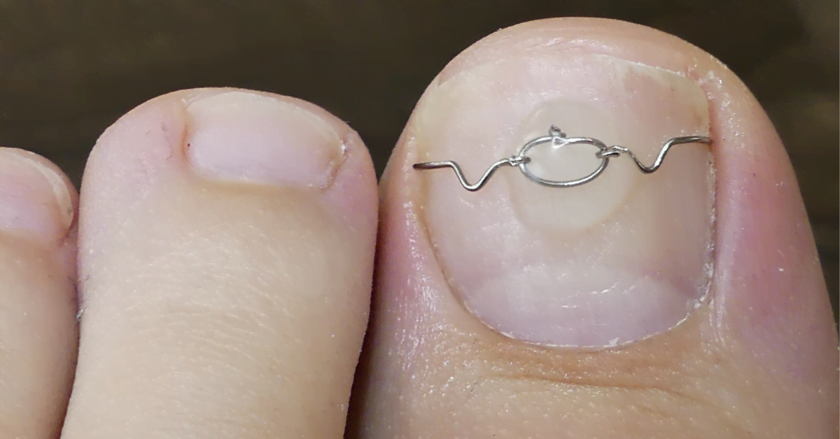 Ingegroeide nagel – behandeling en preventie