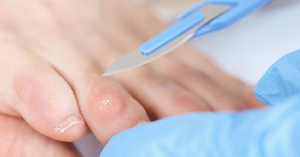 Likdoorn – eksteroog op voet